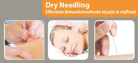 Dry Needling